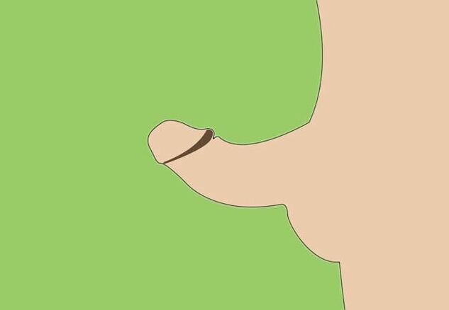 zakrivljenost penisa kao indikacija za kirurško povećanje